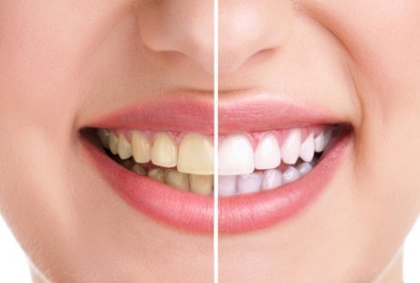 How To Whiten Your Teeth With Turmeric