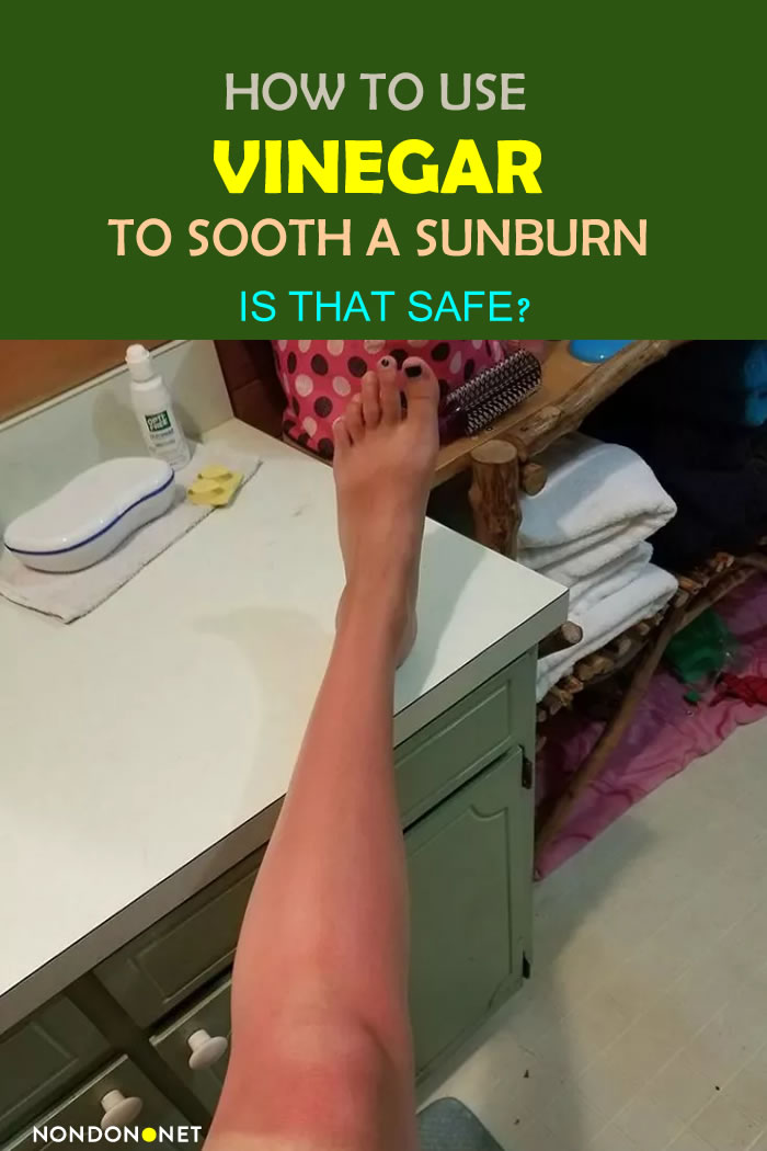 How to Use Vinegar to Sooth a Sunburn? Is that Safe? #Vinegar #AppleCiderVinegar #AppleCider #Sunburn