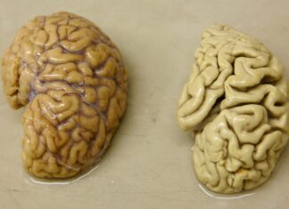 Alzheimer brain vs Normal brain