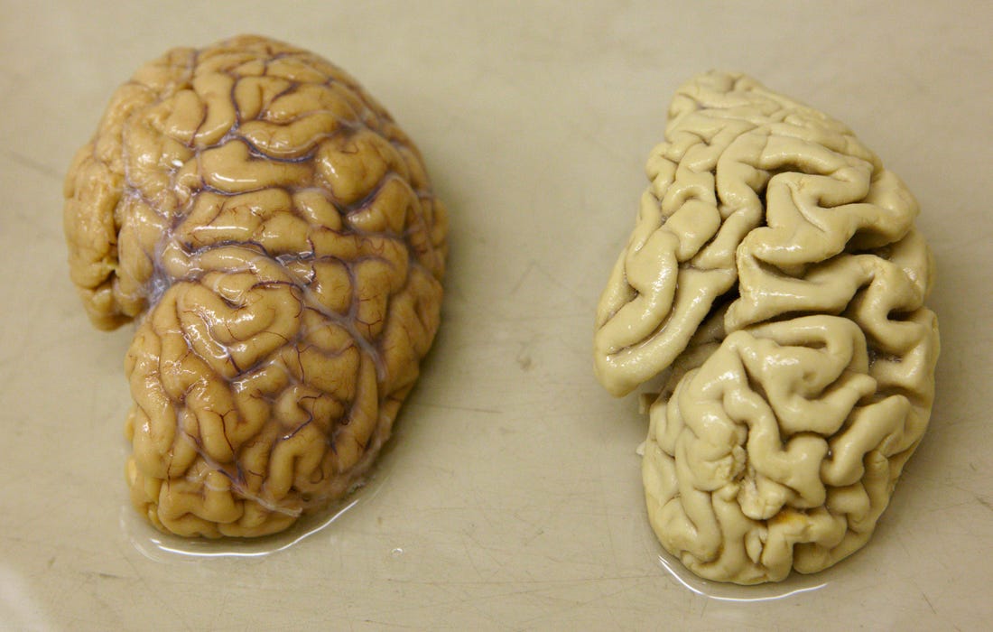 Alzheimer brain vs Normal brain