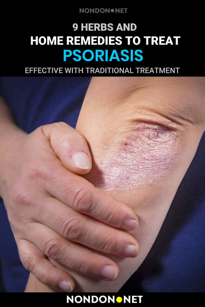 9 Herbs And Home Remedies To Treat Psoriasis Naturally